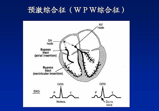 wpw综合症是什么病？