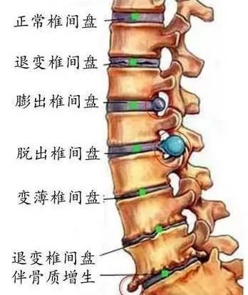 腰椎间盘退行性变是怎么回事?