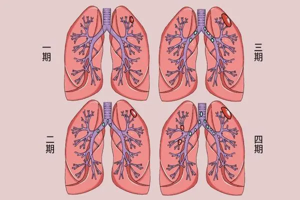 lung是什么意思