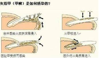 灰指甲怎么根治？