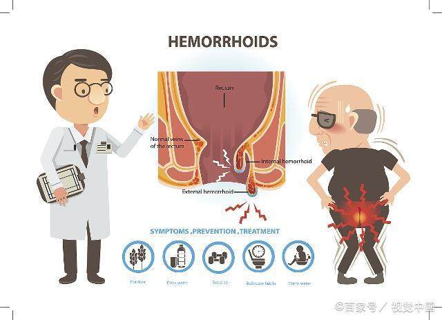 怎么预防痔疮呢?