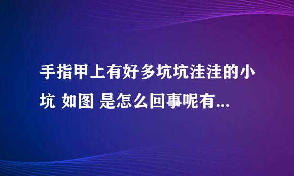 手指甲上有好多坑坑洼洼的小坑 如图 是怎么回事呢有人知道吗