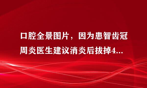 口腔全景图片，因为患智齿冠周炎医生建议消炎后拔掉4颗智齿，请名医为我分析下，给出建议