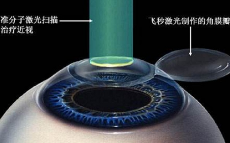 做飞秒激光多少钱