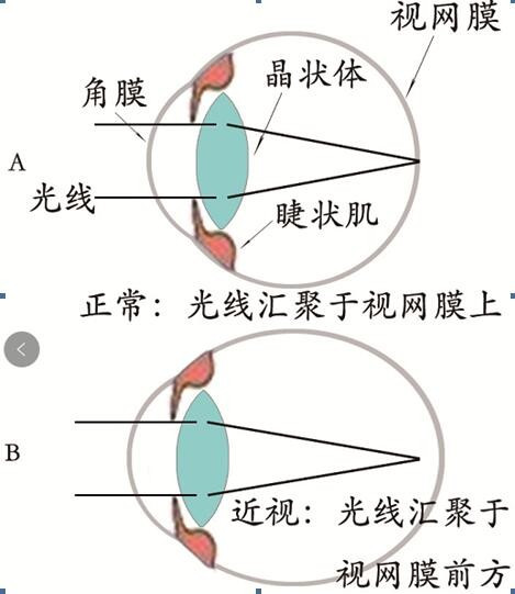 怎样才能彻底治疗好近视眼