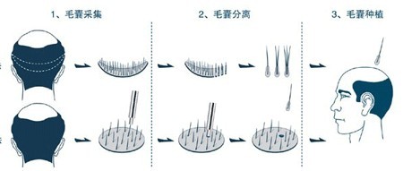 中国最好的植头发机构是哪