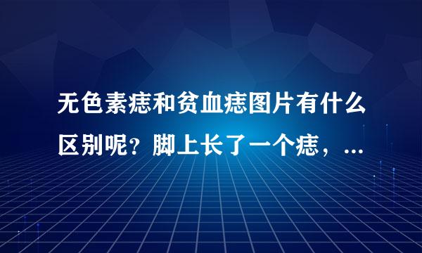 无色素痣和贫血痣图片有什么区别呢？脚上长了一个痣，是这几个星期才长的。