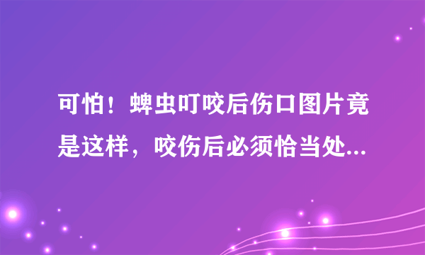 可怕！蜱虫叮咬后伤口图片竟是这样，咬伤后必须恰当处理！ ... 