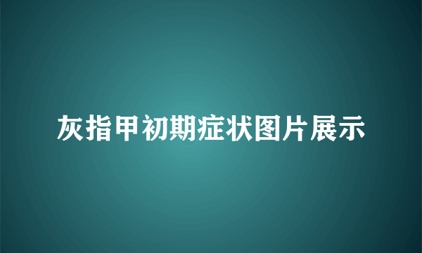 灰指甲初期症状图片展示