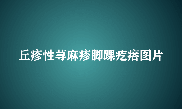 丘疹性荨麻疹脚踝疙瘩图片