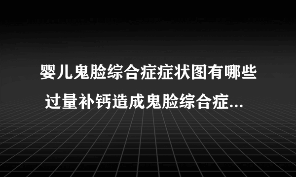 婴儿鬼脸综合症症状图有哪些 过量补钙造成鬼脸综合症的危害是什么