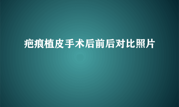 疤痕植皮手术后前后对比照片